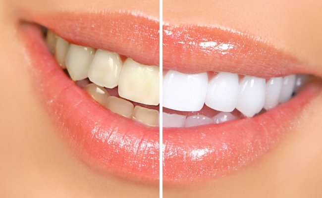 Az esztétikai fogászat fejlődésével egyre nagyobb az igény a szép, fehér fogakra.